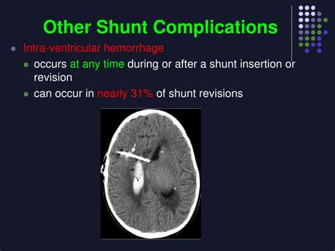 PPT - VP Shunts PowerPoint Presentation - ID:3387790