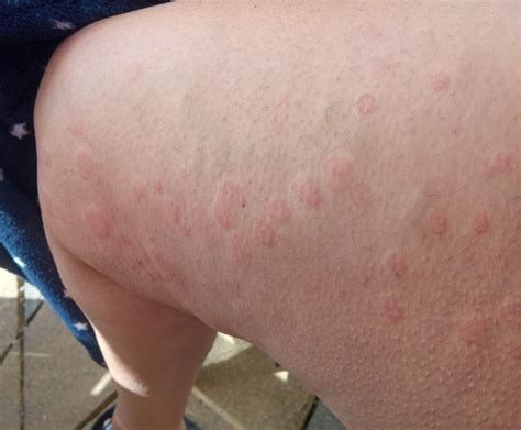 Rashes Could Be 'Key Sign' Of Covid-19. Here's What They Look Like | HuffPost UK Life