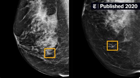 A.I. Is Learning to Read Mammograms - The New York Times