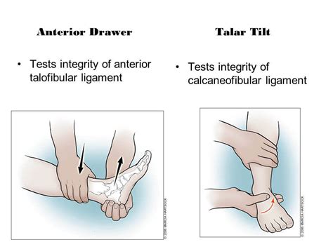 Ligament Tests for Ankle Injuries | Epomedicine