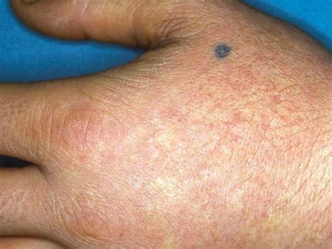 Erythropoietic protoporphyria: Definition, causes, symptoms, and more