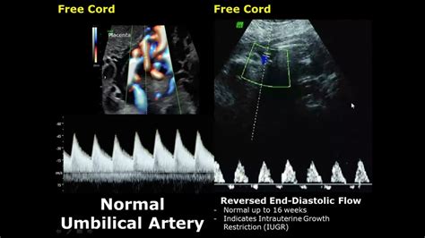 Umbilical Artery Doppler