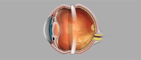 Scleral Buckle Retina Surgery – Devgiri Memorial Hospital