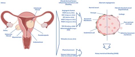 Frontiers | Uterine Fibroids (Leiomyomata) and Heavy Menstrual Bleeding