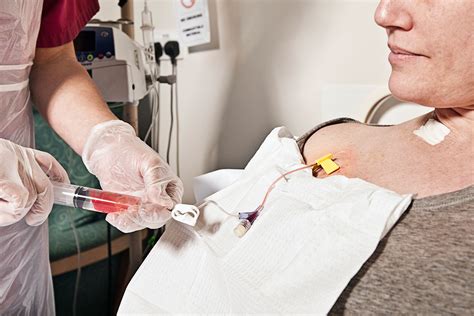 Chemo Ports for Breast Cancer Treatment: What to Know