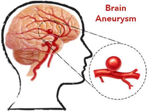 Brain Aneurysm Causes, Symptoms, Diagnosis and Treatment - Natural ...