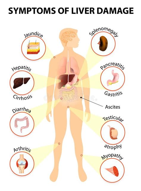 Symptoms of Liver Disease stock vector. Illustration of gallbladder ...