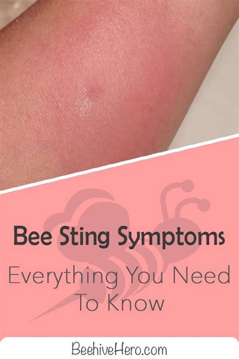 Bee stings can cause different reactions in people depending on various factors. Click the link ...