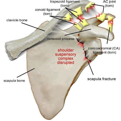 Clavicle Fracture | Scapula Fracture | Floating Shoulder