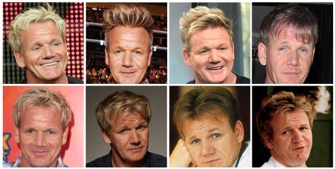 Gordon Ramsay Hair Transplant Before and After