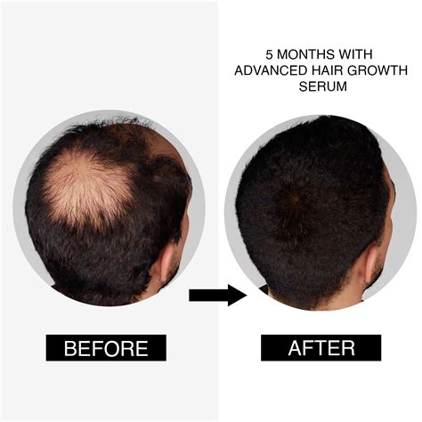 Update more than 153 hair growth solution best - POPPY