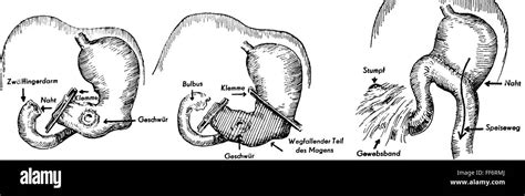 medicine, surgery, phases of gastric resection after Billroth II Stock Photo: 95422002 - Alamy