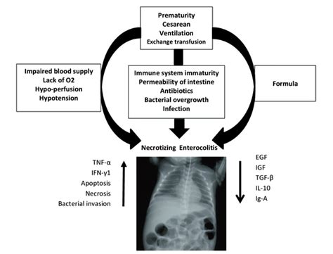 The Impact of Maternal Breast Milk in Preventing Necrotizing ...