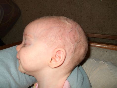 Sagittal Craniosynostosis: December 2008