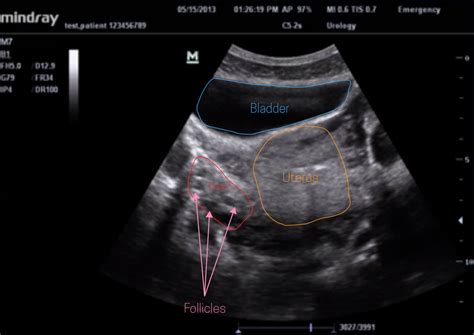 Ultrasound Leadership Academy: The Basics of Pelvic Transabdominal Ultrasound — EM Curious