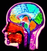 Alzheimer’s Disease – DrKassicieh.com – Sarasota Neurologist