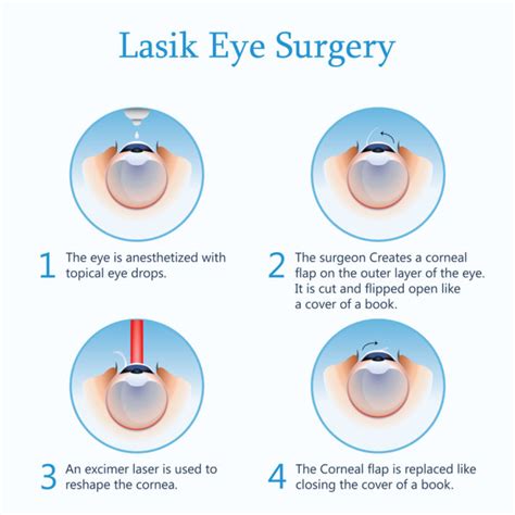 LASIK Procedure: How Does LASIK Work | Eye Pain Center