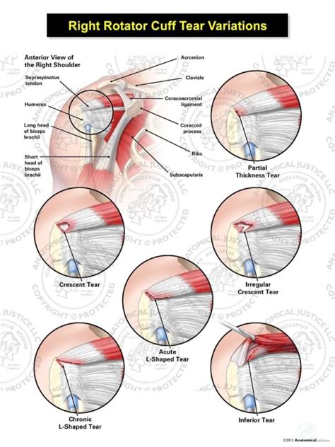 Rotator Cuff Tear Diagram