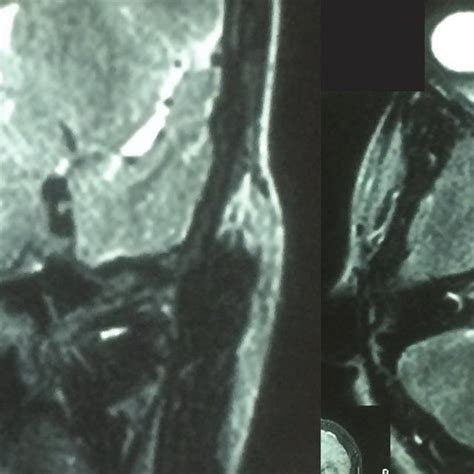 (PDF) Ipsilateral Hemichorea-hemiballism in a Case of Postoperative Stroke