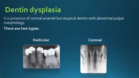 Dentin dysplasia - link10.ir | link10.ir