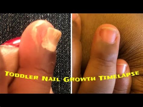 Fingernail Regrowth Time-Lapse | Toddler Fingernail | Finger Nail ...