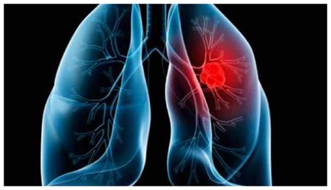 Que Es Una Trombosis Pulmonar - Papel De La Ecocardiografia Transtoracica En El Tromboembolismo ...