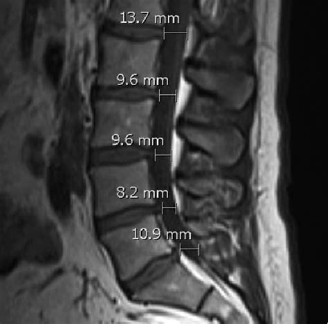 Anteroposterior diameter of the spinal canal measured on MRI (axial T2... | Download Scientific ...