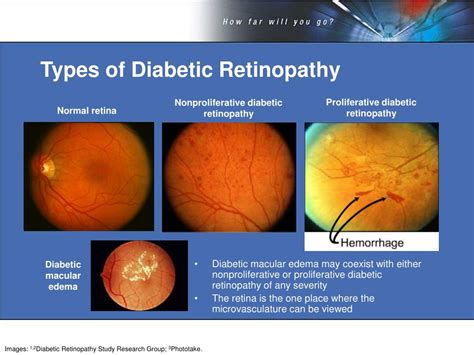 Diabetic Retinopathy Staging