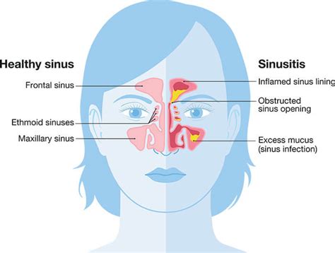 Sinus Care St. Petersburg | Sinusitis St. Petersburg | Third Coast