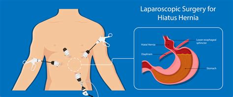 Fundoplication — Hepatobiliary & Upper Gastrointestinal Surgery