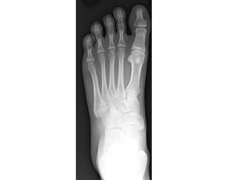 Accessory Ossicles of the Foot (X-Ray Anatomy) Quiz