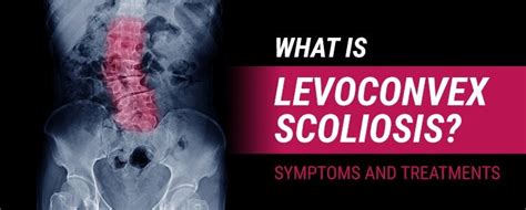 What is Levoconvex Scoliosis? Symptoms and Treatments