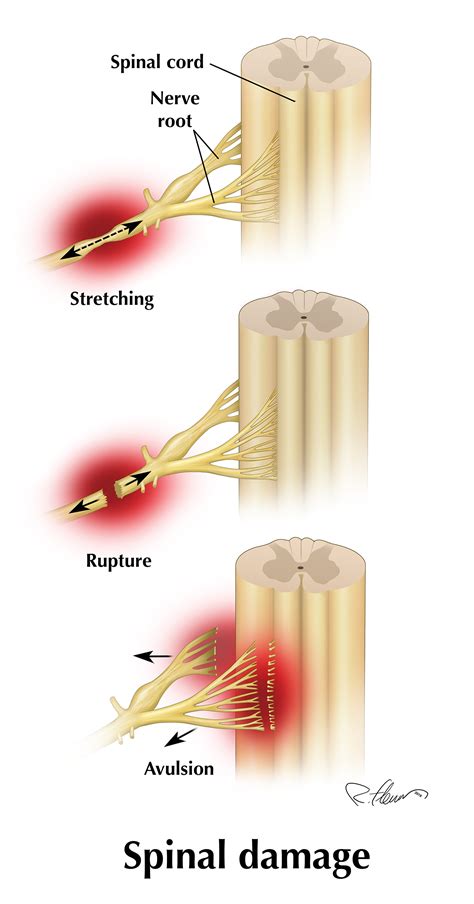 brachial plexus injury car accident settlement - rene-fangman