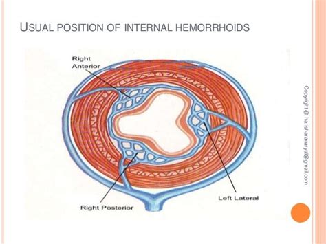 Piles, fistula management via kshar sutra method