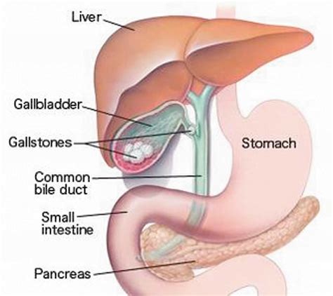 Cholecystitis - Acute & Chronic - Causes, Symptoms & Treatment