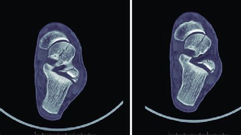 Fracture extension to the talar head and impaction of the middle facet ...