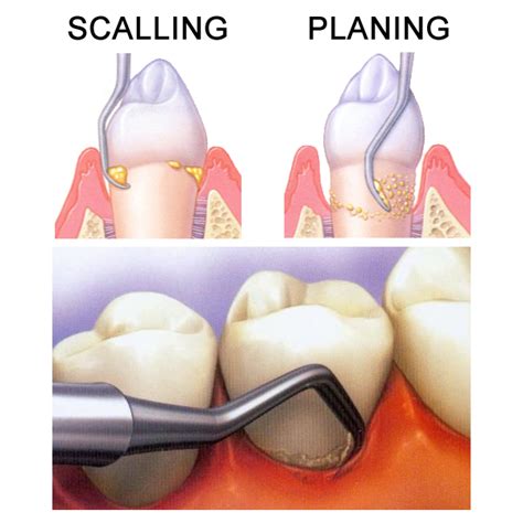 Deep Cleaning Spring TX | Spring Complete Care Dentistry | Periodontics