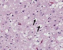 Prion disease + brain imaging Flashcards | Quizlet