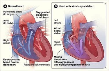 PFO/ASD Closure - Interventional Cardiology - Willis-Knighton Heart ...