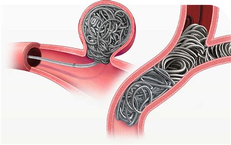 Peripheral Embolization | Penumbra Inc