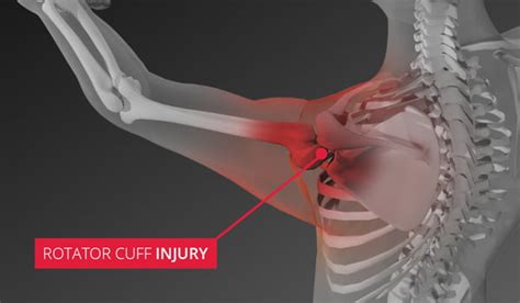 Rotator Cuff Injury Types