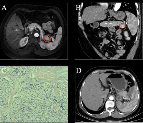 Treatment of insulinomas by laparoscopic radiofrequency ablation: case ...