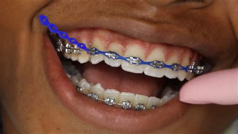 Watch BEFORE Getting POWER CHAIN on your braces.. - YouTube