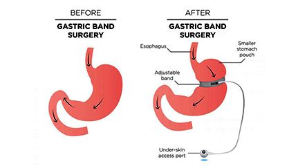 Gastric Banding Cost in India, Lap Band Surgery Cost in India