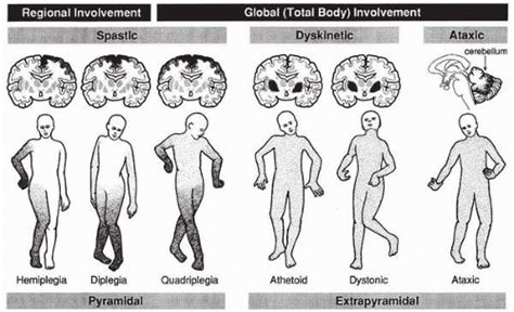 Static Encephalopathies and Common CNS Anomalies | Neupsy Key