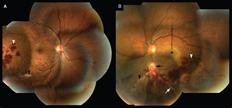 Sarcoidosis Eye