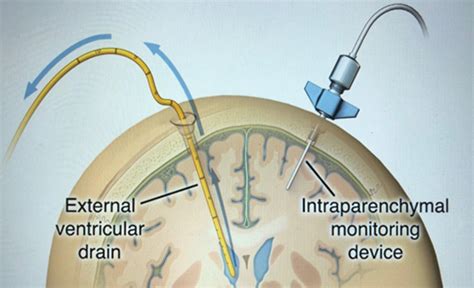 Placement of an External Ventricular Drain | NEJM