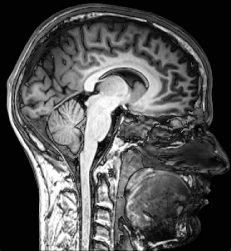 mri scan normal brain sagital view - Neuroscience News