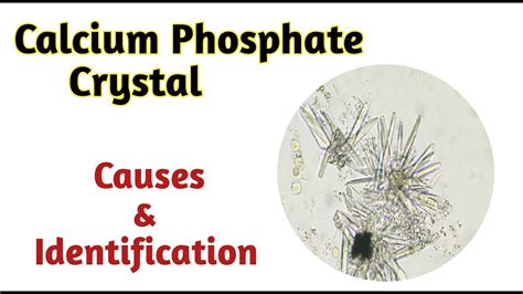 Calcium Phosphate Crystals In Urine