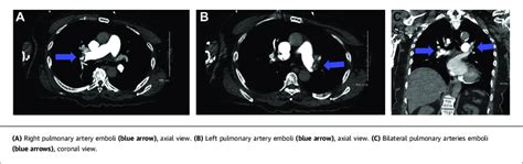 Bilateral Pulmonary Arteries Embolism | Download Scientific Diagram